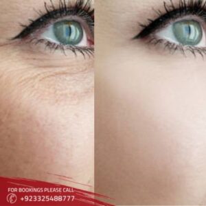 Botox Fillers in Islamabad