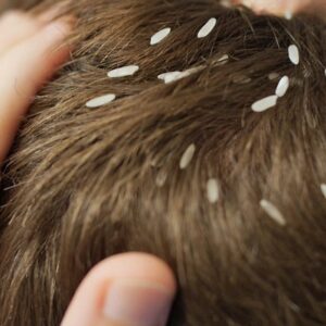 Can Hair Wigs for Men Cause Lice?