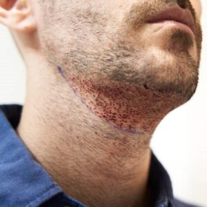 Can I Eat After a Beard Transplant?
