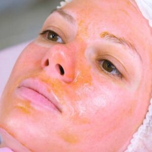 Can I Wash My Face After A Chemical Peel?