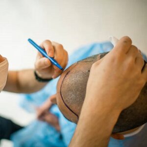 Can I shave head after FUE?