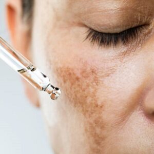 Use sunscreen after the melasma treatment