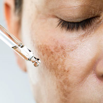 Can I use sunscreen after the melasma treatment?