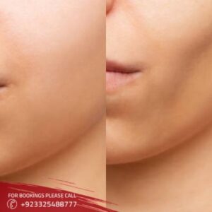 Cheek augmentation in Islamabad
