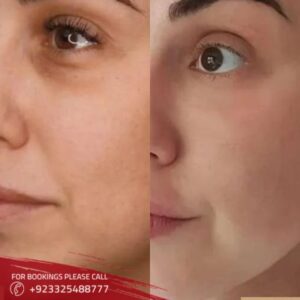 Dark circles treatment in Islamabad (1)
