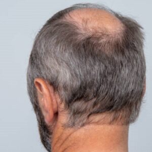 Does fue hairtransplant leaves scar?