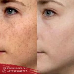 Freckles And Blemishes