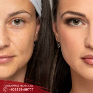 Freckles And Blemishes in Islamabad