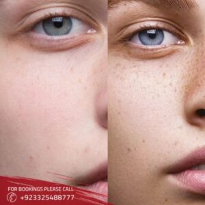 Freckles And Blemishes in Islamabad,pakistan