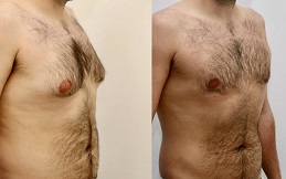 Gynecomastia before and after in Islamabad