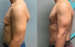 Gynecomastia in Islamabad
