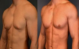 Gynecomastia