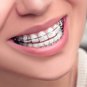 How fast can braces work?
