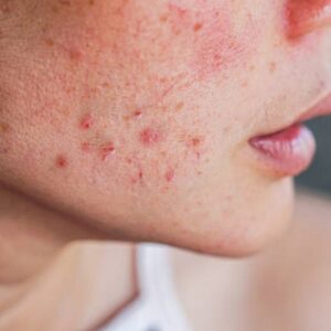 How to Treat the Different Types of Acne Scars?