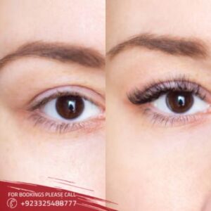 Images of brow lift in Islamabad