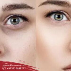 Laser Dark Circles Treatment in Islamabad, Rawalpindi & Pakistan