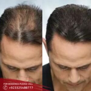Results of FUE hair transplant in Islamabad