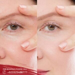 Results of brow lift in islamabad