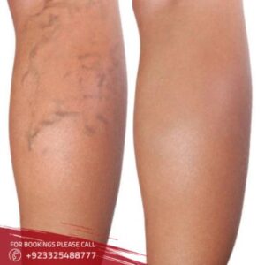 Spider Veins Treatment