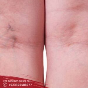 Spider Veins Treatment (1)