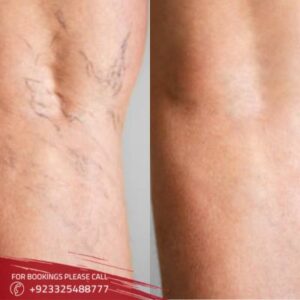 Spider Veins Treatment in Islamabad (1)
