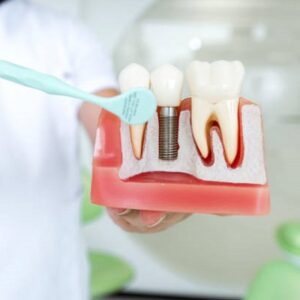 Trusted Dental Implants in Islamabad for a Beautiful Smile