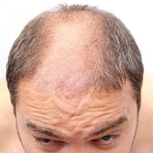 Sunscreen should be used after a hair transplant