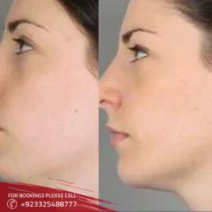 before after of Cheek Augmentation in Islamabad