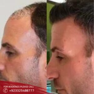 before after of FUE Hair Transplant