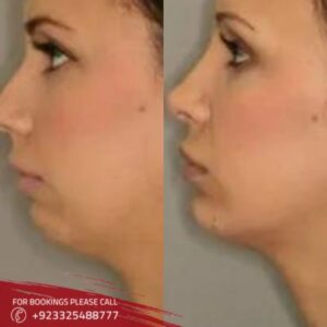 before after of Jaw Surgery in islamabad