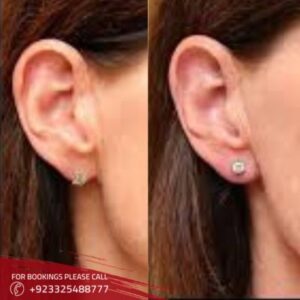 before after of earlobe correction in Islamabad