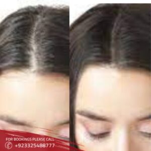 before after of hair loss treatment