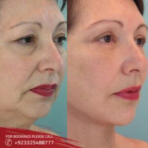 _before after of magic facelift in Islamabad