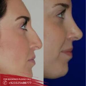 before after of non surgical nose job