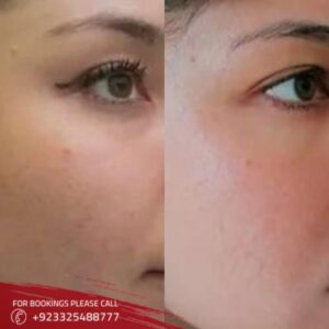 before after of vampire face lift in islamabad