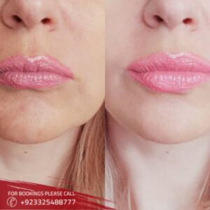 before after of volite Fillers in Islamabad (1)