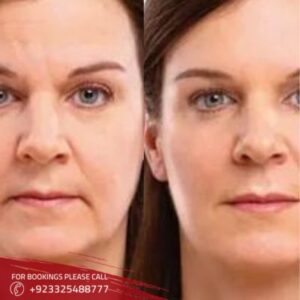best stem cell facelift in Islamabad