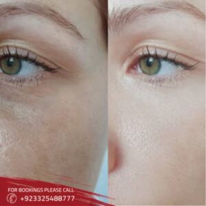 botox treatment in Islamabad