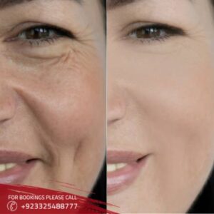 image of non-surgical facelift in Islamabad