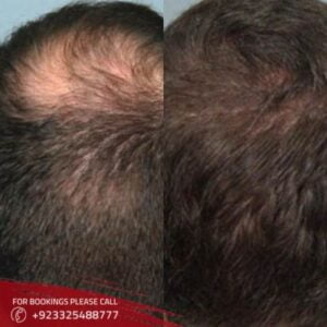 images of FUE hair transplant in Islamabad