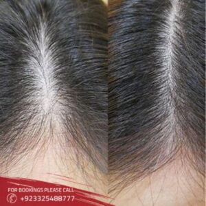 images of hair loss treatment in Islamabad