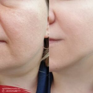 images of neck lift in Islamabad