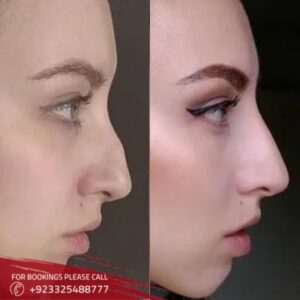 images of non surgical nose job in Islamabad