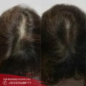 results of hair loss treatment in Islamabad