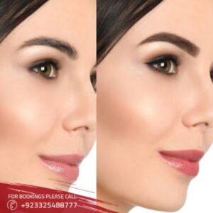 before after of brow lift in Islamabad