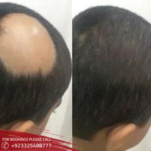 _results Alopecia Areata in Islamabad