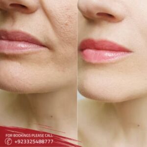 results of Jaw Surgery in islamabad