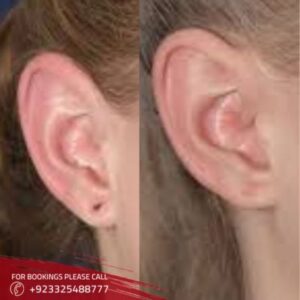 results of earlobe correction in Islamabad