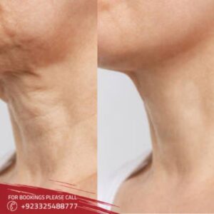 results of neck lift in Islamabad
