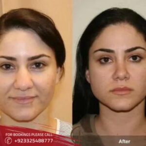 results of non surgical nose job in Islamabad